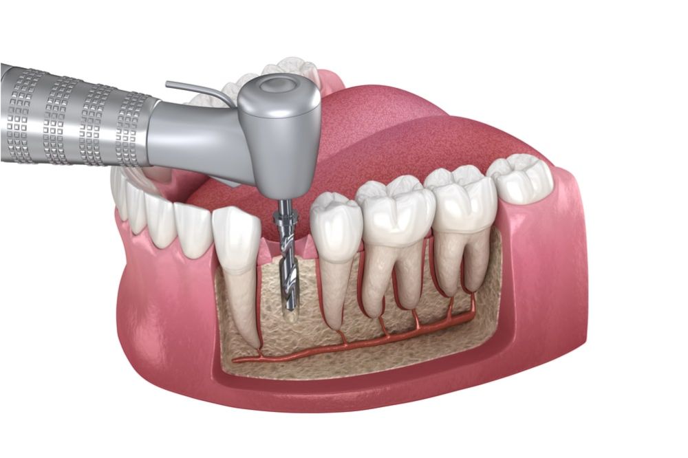 Root Canal